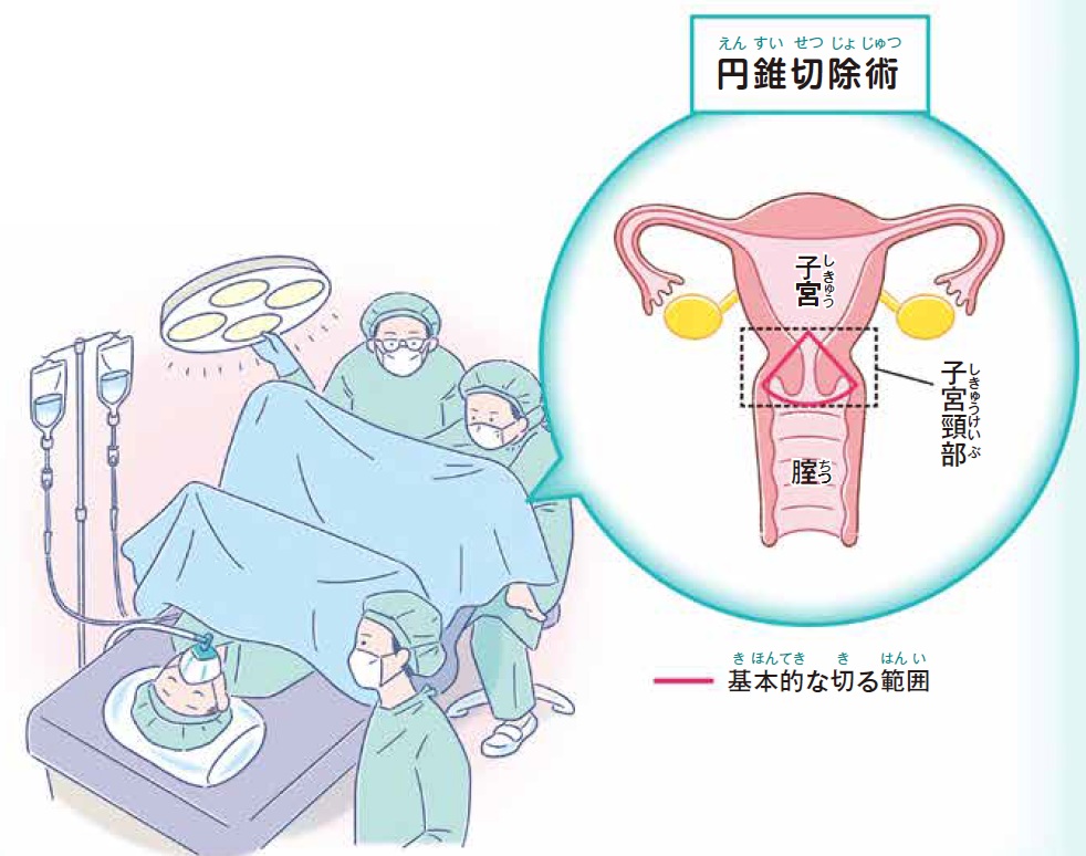 イラスト。円錐切除術。基本的な切る範囲は、子宮と膣の間にある子宮頚部だけ。